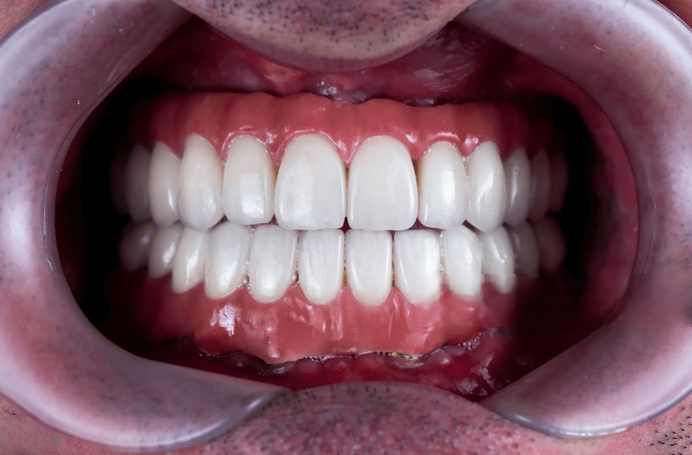 PROTESI-TORONTO-BRIDGE-PADOVA-2