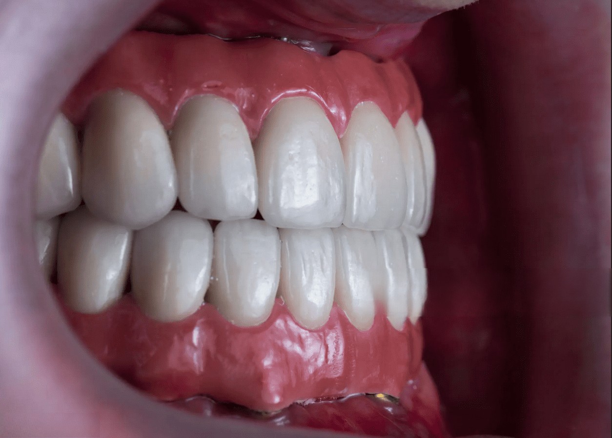 PROTESI-TORONTO-BRIDGE-PADOVA-6