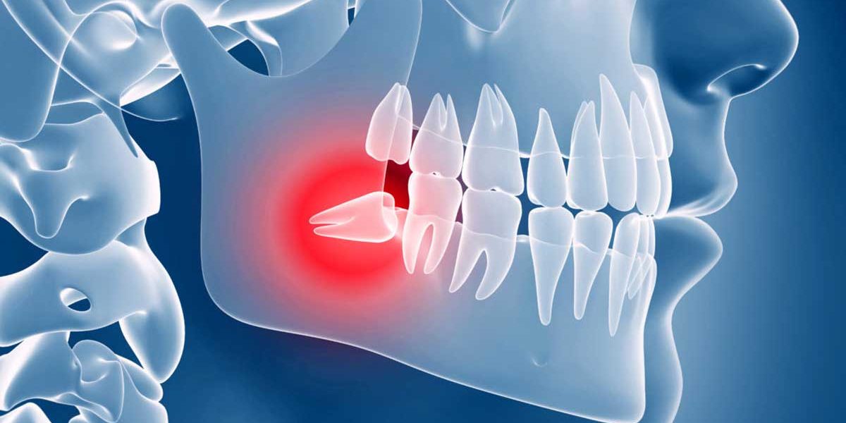 denti-giudizio-1200×600-1